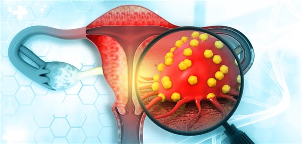 Im Fokus der aktualisierten S3-Leitlinie: Krebszelle auf dem Endometrium.