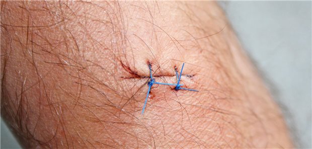 Im Gegensatz zur konfokale Laser-Scanning-Mikroskopie zur Hautkrebs-Abklärung ist die Biopsie in der Regel „blutig“, da sie mit Skalpell, Exzision, Naht und histologischer Untersuchung erfolgt.