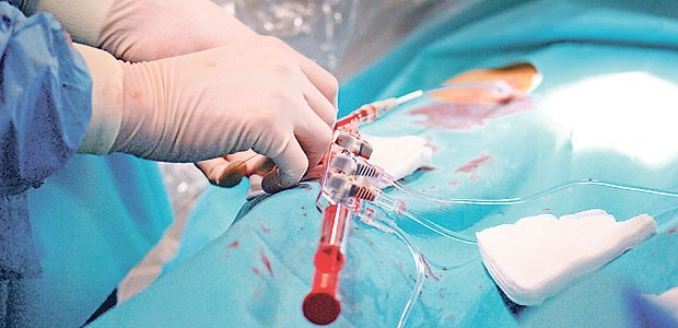 Absaugen des Thrombus löst nicht den Fall Im Herzkatheterlabor: primäre perkutane Koronarintervention.
