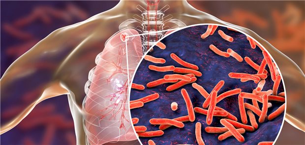 Im Jahr 2023 wurden 10,8 Millionen Neuerkrankungen und 1,25 Millionen Todesfälle durch Tuberkulose registriert, mit stark heterogener globaler Verteilung.
