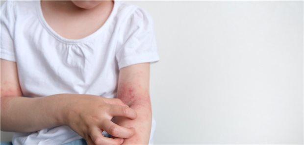 Im Kindesalter sollte die Indikation für eine Systemtherapie bei atopischer Dermatitis besonders sorgfältig gestellt werden. Hilfreich sei dabei eine in der S3-Leitlinie enthaltene Checkliste, die relevante Kriterien für die Einleitung einer Systemtherapie oder die Umstellung auf eine andere Systemtherapie bei Kindern vorgibt, sagte Prof. Dr. Sonja Molin.