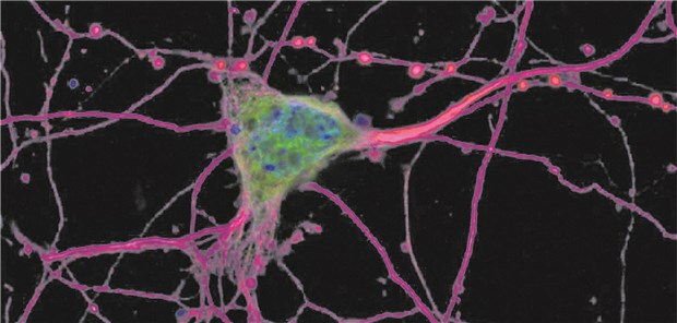 Bluttest auf ALS vereinfacht die Differentialdiagnose Im Krankheitsverlauf der Amyotrophen Lateralsklerose sterben immer mehr Motoneurone ab. Dabei ist eine Unterscheidung von anderen neurodegenerativen Erkrankungen nicht immer einfach.