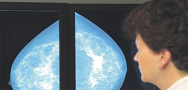 Haben Radiologen den richtigen "Riecher"? Im Mammografie-Bild lassen sich feine Details in der Gewebsstruktur der Brust erkennen.