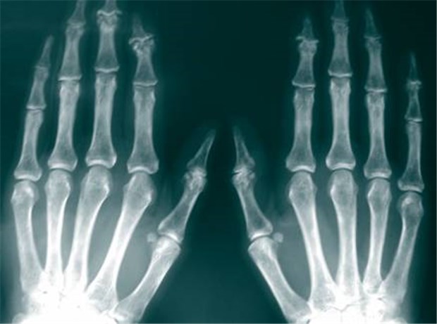 Der diagnostische Blick - ist es eine Polyarthritis oder eine Polyarthrose? Im Röntgenbild sichtbar werden Verschmälerungen der Gelenkspalten an den Fingermittelgelenken.
