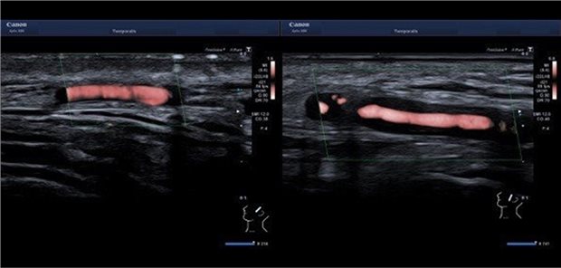 Im Vergleich zum Normalbefund (links) zeigt sich in der Powerdoppler-Sonographie der Arteria temporalis auf der rechten Abbildung eine deutliche, ödematöse, echoarme Wandverdickung. Das Gefäßlumen ist dadurch eingeengt.