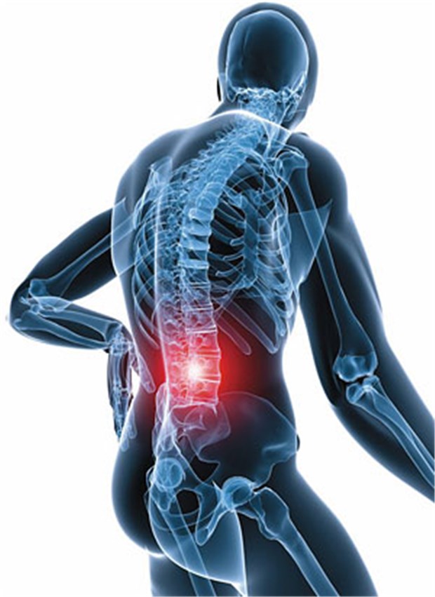 Spinalkanalstenose bei Gehproblemen oft übersehen Immer mehr Menschen suchen wegen Beschwerden die Wirbelsäulenchirurgen auf.