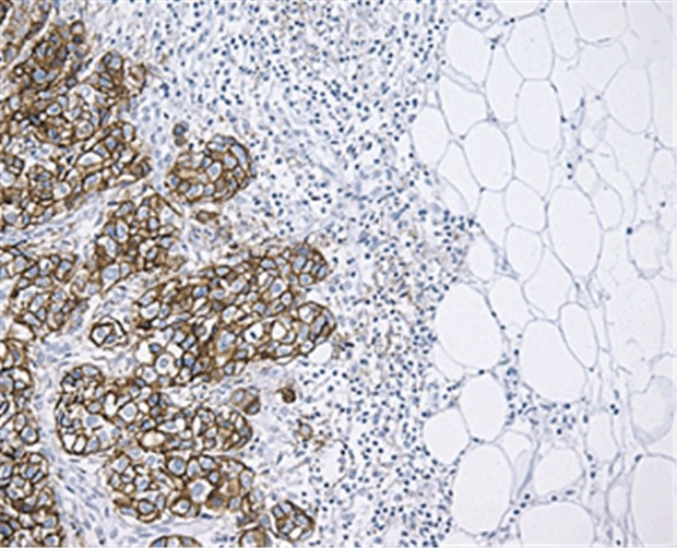 Immunhistochemie erleichtert Wahl der Aszitestherapie Immunhistochemie von EpCAM bei Brustkrebs. Braun bedeutet, dass viel EpCAM-Protein im Gewebe vorliegt.