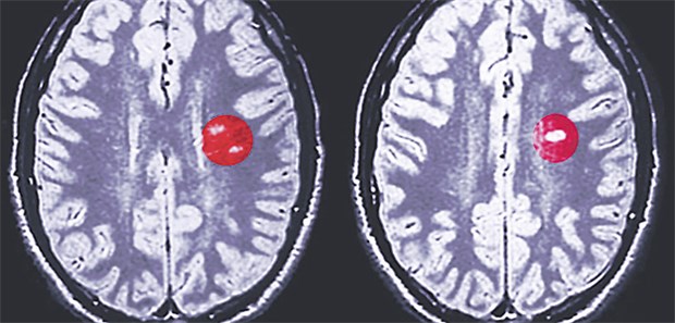 Frühe MS-Therapie lohnt sich Immunmodulatoren reduzieren MS-Schäden (rot) und verzögern die Progression.