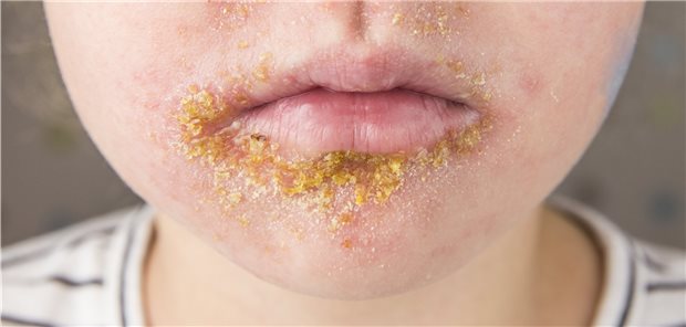 Impetigo bei einem fünf Jahre alten Kind.