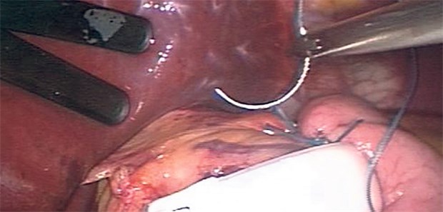Diabetiker profitieren Jahre von Adipositas-Chirurgie Implantation eines Magenbandes.