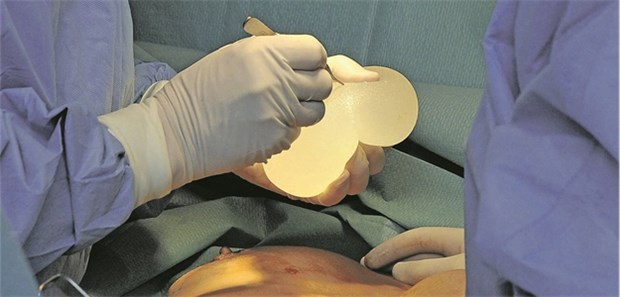 Zunehmend Lymphome als Spätfolge bei Brustimplantaten? Implantation eines Silikon-Kissens. Etwa 10-15 Millionen Frauen tragen ein Brustimplantat.