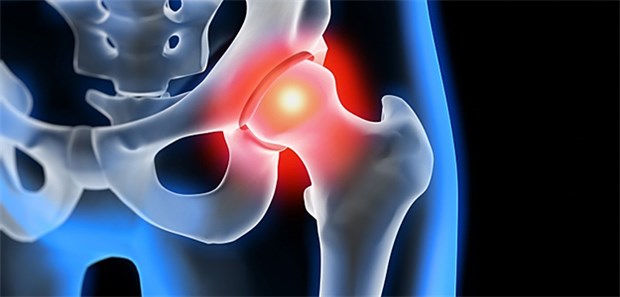 Schäden durch Nanopartikel aus der Endoprothese? Implantatsicherheit: Forscher fanden bei einem Patienten viele Metall-Partikelchen in der Gewebeumgebung der Hüftendoprothese.