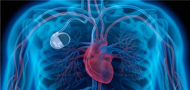 Implantierter Kardioverter (ICD): Ob die Implantate heute noch von Vorteil sind, haben Forscher aus ganz Europa untersucht.