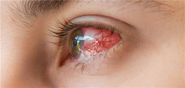 In 20 Prozent einer Pilkeratitis handelt es sich um eine Koinfektionen mit Bakterien – oft Fusarien plus Staphylokokken – sollten Antibiotika bei bakterieller Keratitis und Pilzverdacht Pilze einigermaßen mitabdecken. Infrage kommen Chloramphenicol, Moxifloxacin oder Tobramycin. Wenn auch nicht so gut wie Antimykotika, wirken sie immerhin gegen Fusarium.