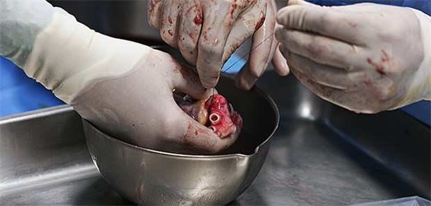 Vor 50 Jahren erstmals Herz transplantiert In Deutschland finden rund 300 Herztransplantationen pro Jahr statt.