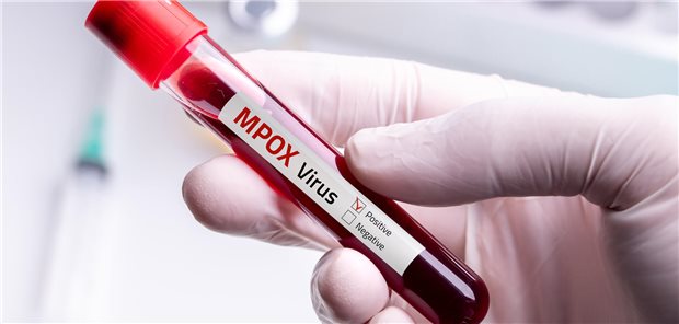 Neue Mpox-Variante Klade Ib: Erster Fall in Deutschland Blutprobe mit der Aufschrift "MPox"