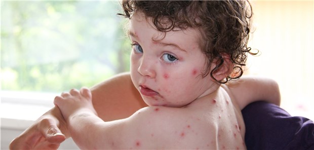 In Deutschland nur noch selten: Kleinkind mit Windpocken.