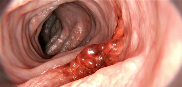 Blick in den Darm mit einem Krebsgeschwür.