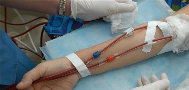 In Spanien hatten Dialyse-Patienten, die mit SARS-CoV-2 infiziert waren, im Vergleich zu nierengesunden COVID-19-Patienten ein vierfach höheres Sterberisiko.