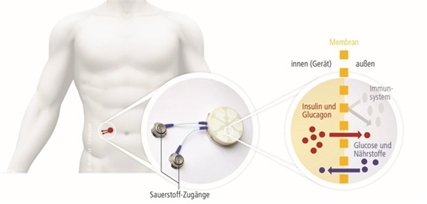 Bioreaktor mit Inselzellen macht Fortschritte In dem Bioreaktor sind die Inselzellen vom Schwein vor Abstoßungsreaktionen des Immunsystems geschützt. Durch eine Membran gelangen Insulin hinaus sowie Nährstoffe und Glukose hinein.