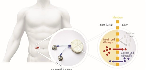 Bioreaktor mit Inselzellen macht Fortschritte In dem Bioreaktor sind die Inselzellen vom Schwein vor Abstoßungsreaktionen des Immunsystems geschützt. Durch eine Membran gelangen Insulin hinaus sowie Nährstoffe und Glukose hinein.