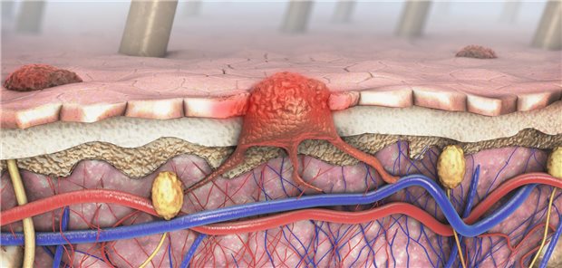 Dreidimensionale Darstellung eines Querschnitts der menschlichen Haut mit einem Melanom, das in den Blut- und Lymphkreislauf eindringt.