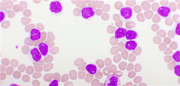 Mikroskopieaufnahme eines Blutbild bei chronischer lymphatischer Leukämie (CLL).