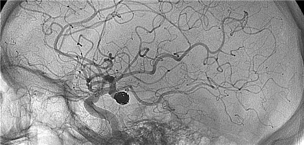 In der Studie hatten sich die Aneurysmen bei Patienten mit Nasopharynx-Ca etwa vier Jahre nach Radiatio gebildet.