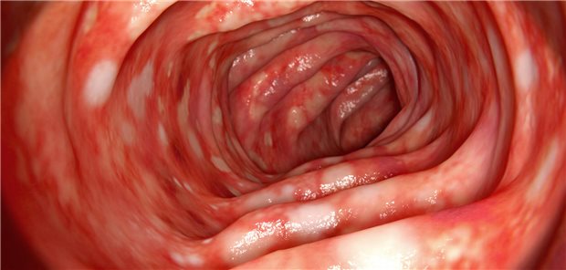 Endoskopische Aufnahme der Schleimhaut des Darms eines Patienten mit Colitis ulcerosa.