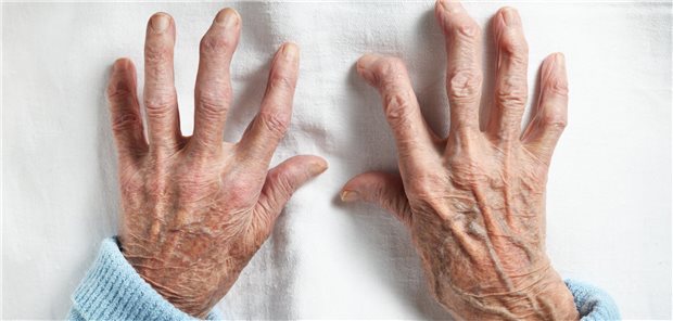 In der Tapering-Gruppe waren Rezidive erkennbar an weniger Tregs, höhere CRP-Werte, eine Blutsenkungsbeschleunigung und mehr IRC. Eine Vorhersage eines Schubes war anhand Tregs, IRC und CRP zu 81,7 Prozent akkurat. In der Gruppe mit unverändert fortgesetzter Therapie waren Rezidive erkennbar an der Zahl druckschmerzhafter Gelenke, der Powerdoppleraktivität und der Schmerz-VAS. Eine Vorhersage eines Schubes war mit 82,1-prozentiger Genauigkeit möglich.