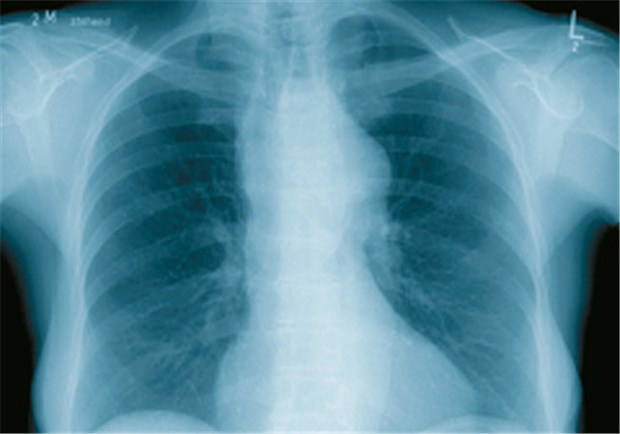 Aortenaneurysma war Ursache von plötzlichen Schluckstörungen In der Thoraxröntgenaufnahme der Patientin fiel auf, dass das obere Mediastinum erheblich verbreitert war.