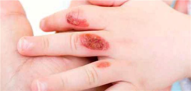 Brandverletzung auf den Fingern eines Kindes