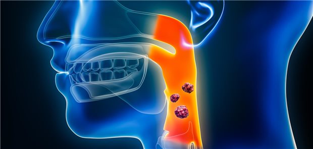 Dreidimensionale gerenderte Illustration von Pharynx- oder Kehlkopfkrebs.