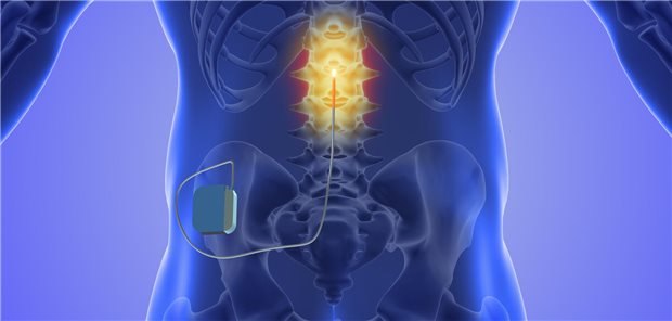 Dreidimensionale Darstellung des medizinisches Konzept der Rückenmarkstimulation in der Behandlung chronischer Rückenschmerzen.