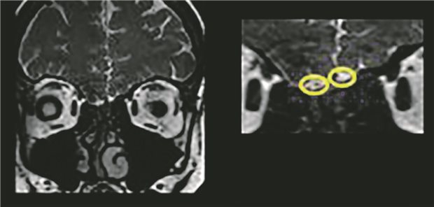 In einer MRT-Untersuchung wird klar: Der Patientin fehlen beide Riechkolben. Andernfalls müssten sie hier unterhalb des Sulcus olfactorius (gelb umkreist) zu erkennen sein.