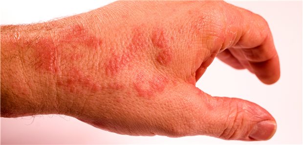 In einer Studie besserte sich das Handekzem schneller, wenn die Probanden per SMS ans Eincremen erinnert wurden.