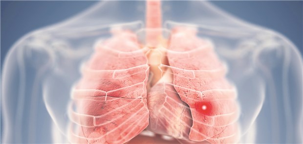 NSCLC – Forscher entdecken Virus-DNA im Tumorgewebe In einer Studie enthielten die meisten Gewebeproben von nicht kleinzelligen Lungentumoren , die sie untersucht hatten, virale DNA.