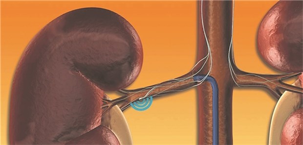 In einer aktuellen Studie hat die renale Denervation positive Ergebnisse gezeigt.