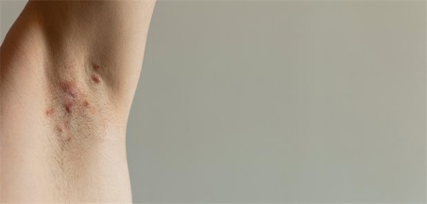 Woher kommt die Fettleber bei Hidradenitis suppurativa? Nahaufnahme der Achsel eines Patienten mit sichtbaren roten, schmerzhaften Fisteln welche ein Symptom der chronisch inflammatorischen Hauterkrankung Hidradenitis suppurativa sind.