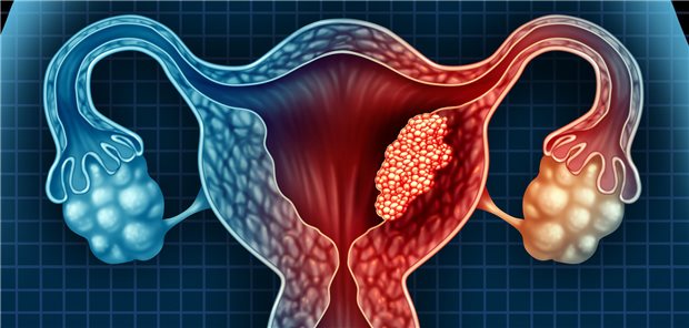 Schematische Darstellung des Uterus mit Eierstöcken