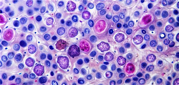 Mikroskopische Ansicht von abnormalem Lymphknotengewebe mit ausgeprägtem follikulärem Muster, charakteristisch für das follikuläre Lymphom, eine Art von Non-Hodgkin-Lymphom-Krebs.