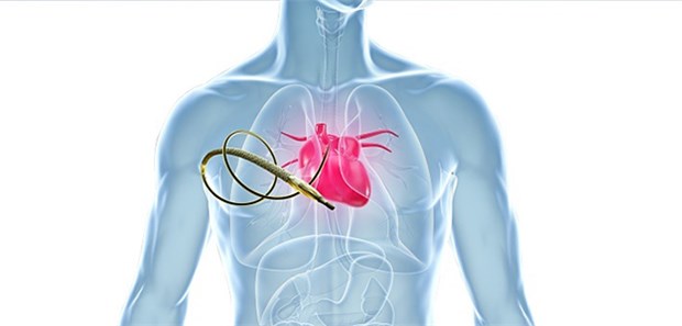 Kardiogener Schock – weniger ist hier mehr Infarkt-Patienten profitieren mehr von der einfacheren und weniger aggressiven Standardstrategie. Dabei wird zunächst nur die "schuldige" infarktrelevante Koronarläsion (culprit lesion) revaskularisiert.