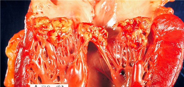 Infektiöse Endokarditis: Meist sind Staphylokokken am Werk.
