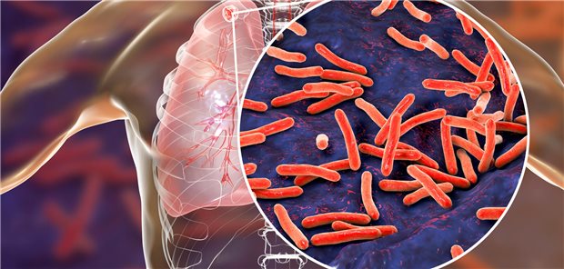 Lunge mit Tuberkulose-Bakterien