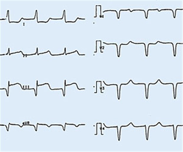 Neuer Stent senkt Komplikationsrate nach Infarkt Initiales EKG bei einem Patienten mit den typischen Zeichen eines STEMI.