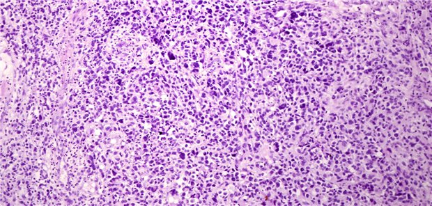VEGFR-Inhibitoren bei Sarkomen: Zwei Biomarker identifizieren Patienten, die besonders profitieren Innerhalb einer Phase-II-Studie zeigte sich die Wirksamkeit von VEGFR-Inhibitoren bei verschiedenen histologischen Sarkom-Subtypen.