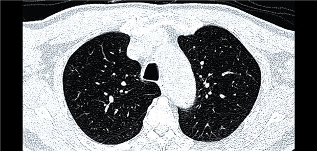 Insgesamt 11,1 Prozent aller Untersuchten präsentierten im CT klinisch relevante Knötchen, die in der Regel weitere Untersuchungen nach sich ziehen. 