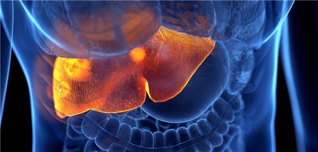 Dreidimensionale gerenderte Illustration von fortgeschrittenem hepatozellulärem Karzinom.