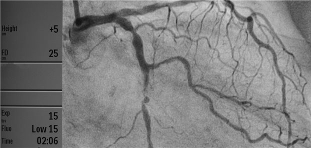 Insgesamt wiesen Patienten mit Diabetes nach der revaskularisierenden Maßnahmen über fünf Jahre hinweg betrachtet ein höheres Sterberisiko auf und waren häufiger von kardiovaskulären Ereignissen betroffen. Dabei zeigten sich aber weder bei Patienten mit noch bei jenen ohne Diabetes signifikante Unterschiede in der Mortalität und im Risiko für frühe Schlaganfälle zwischen PCI- und Bypass-Patienten.