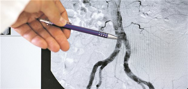Internationale Leitlinien empfehlen die CT-Angiografie von Hirn- und Halsgefäßen als zentralen Bestandteil der Akutdiagnostik beim ischämischen Schlaganfall – weltweit setzen 72 Prozent der behandelnden Neurologinnen und Neurologen diese Untersuchung routinemäßig ein. (Symbolbild)